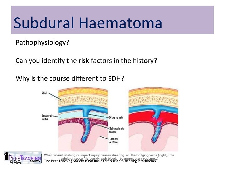 Subdural Haematoma Pathophysiology? Can you identify the risk factors in the history? Why is