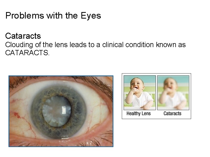 Problems with the Eyes Cataracts Clouding of the lens leads to a clinical condition