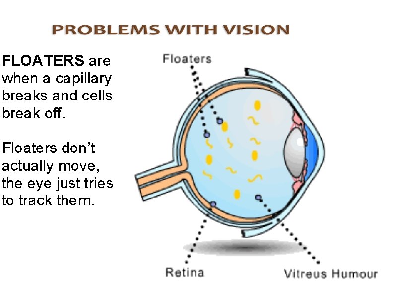 FLOATERS are when a capillary breaks and cells break off. Floaters don’t actually move,