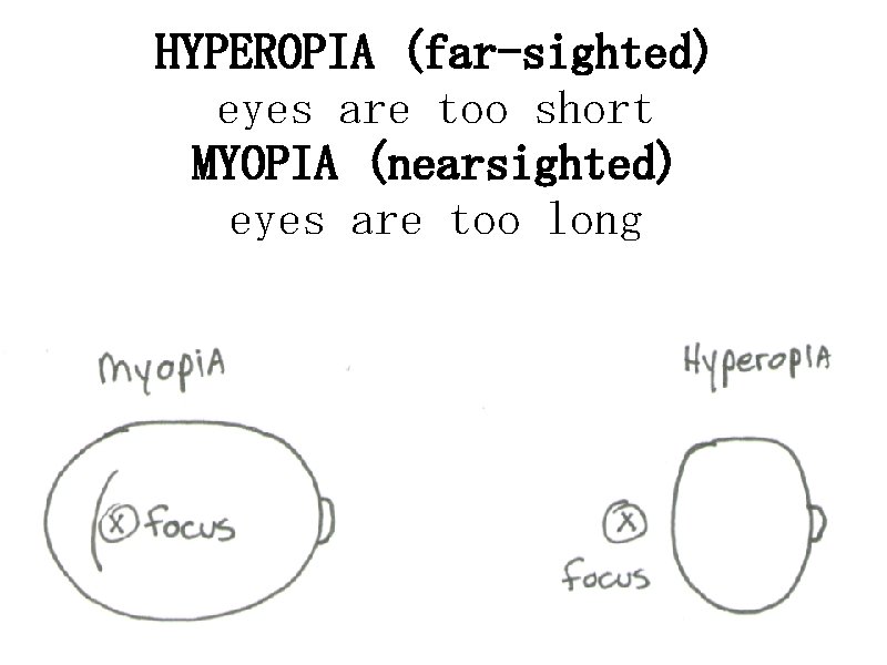 HYPEROPIA (far-sighted) eyes are too short MYOPIA (nearsighted) eyes are too long 