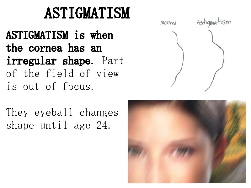 ASTIGMATISM is when the cornea has an irregular shape. Part of the field of