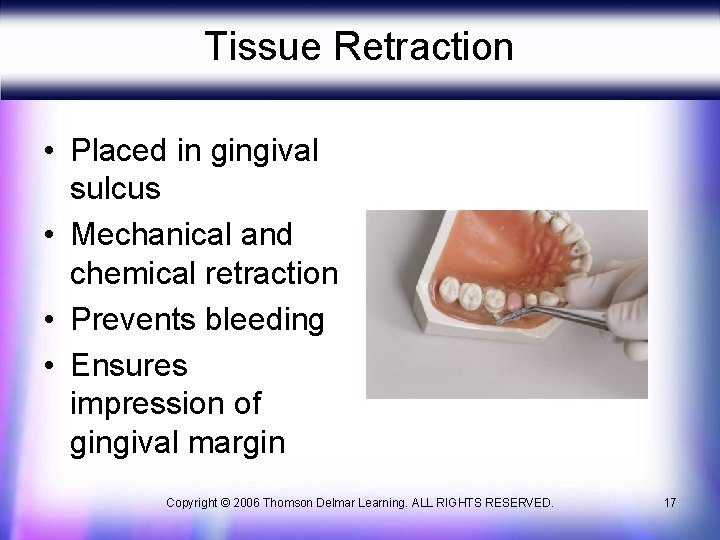 Tissue Retraction • Placed in gingival sulcus • Mechanical and chemical retraction • Prevents