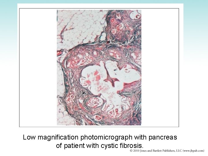 Low magnification photomicrograph with pancreas of patient with cystic fibrosis. 