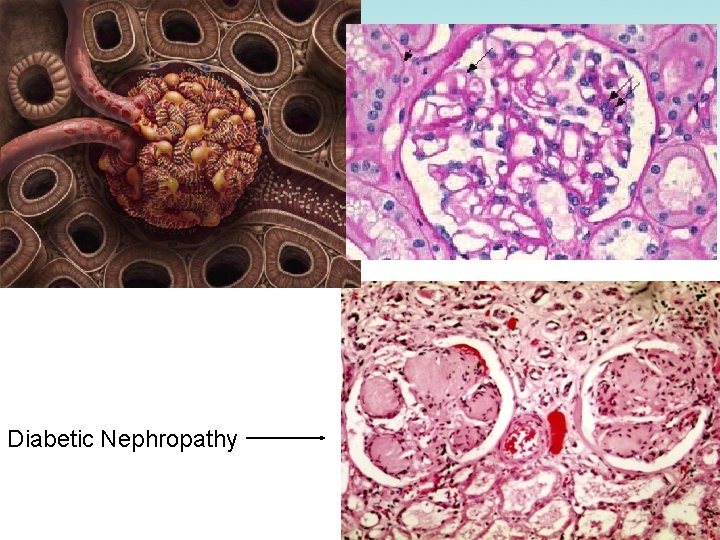 Diabetic Nephropathy 
