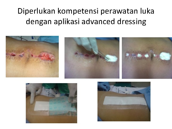 Diperlukan kompetensi perawatan luka dengan aplikasi advanced dressing 