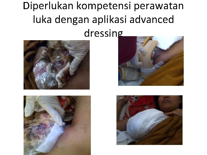 Diperlukan kompetensi perawatan luka dengan aplikasi advanced dressing 