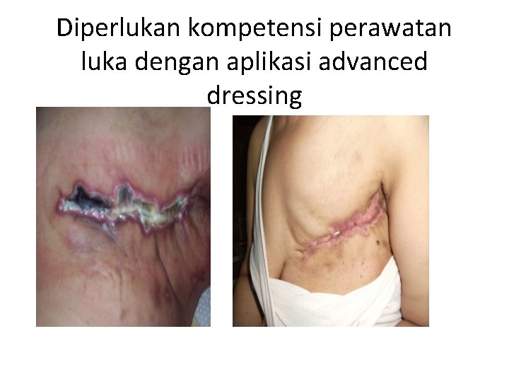 Diperlukan kompetensi perawatan luka dengan aplikasi advanced dressing 