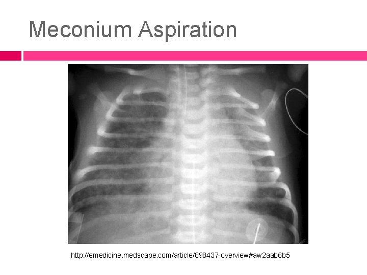 Meconium Aspiration http: //emedicine. medscape. com/article/898437 -overview#aw 2 aab 6 b 5 