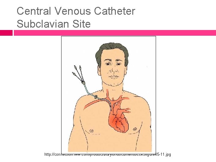 Central Venous Catheter Subclavian Site http: //connection. lww. com/products/taylor/documents/cc 45 figure 45 -11. jpg