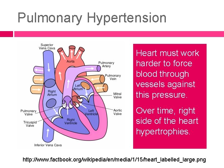 Pulmonary Hypertension Heart must work harder to force blood through vessels against this pressure.