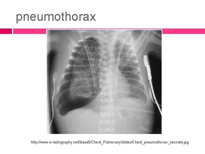 pneumothorax http: //www. e-radiography. net/ibase 5/Chest_Pulmonary/slides/Chest_pneumothorax_neonate. jpg 