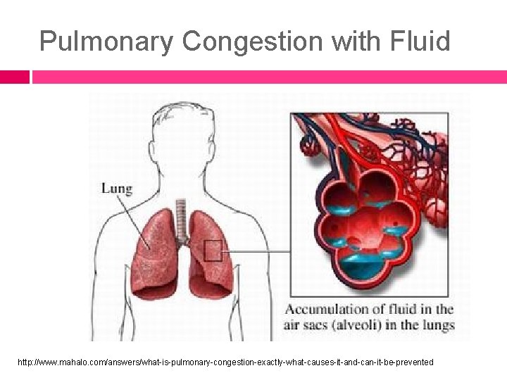 Pulmonary Congestion with Fluid http: //www. mahalo. com/answers/what-is-pulmonary-congestion-exactly-what-causes-it-and-can-it-be-prevented 