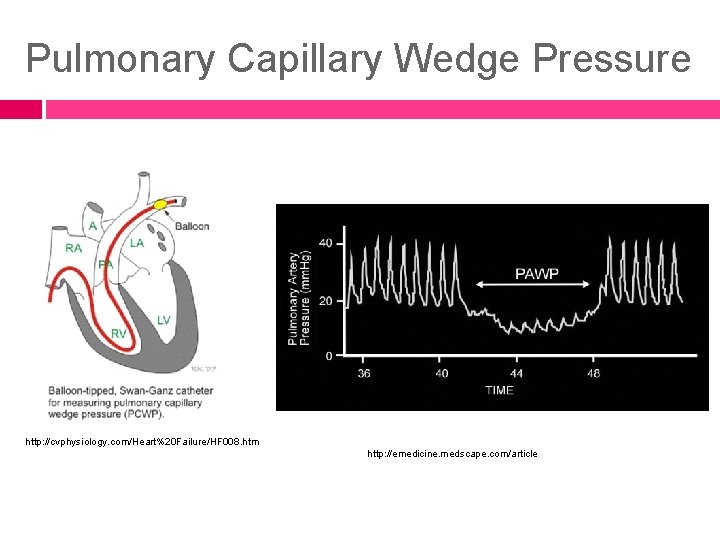 Pulmonary Capillary Wedge Pressure http: //cvphysiology. com/Heart%20 Failure/HF 008. htm http: //emedicine. medscape. com/article