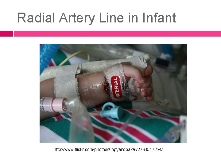 Radial Artery Line in Infant http: //www. flickr. com/photos/zippyandbaker/2763547254/ 