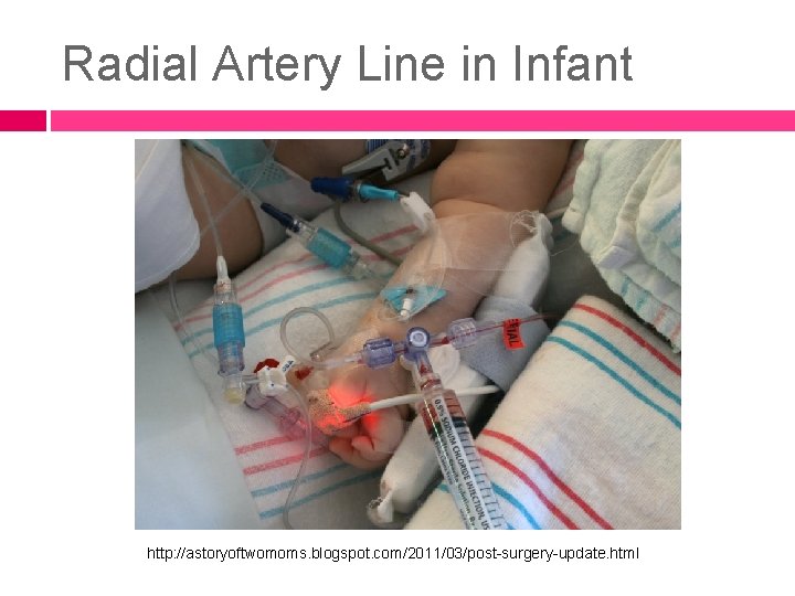 Radial Artery Line in Infant http: //astoryoftwomoms. blogspot. com/2011/03/post-surgery-update. html 