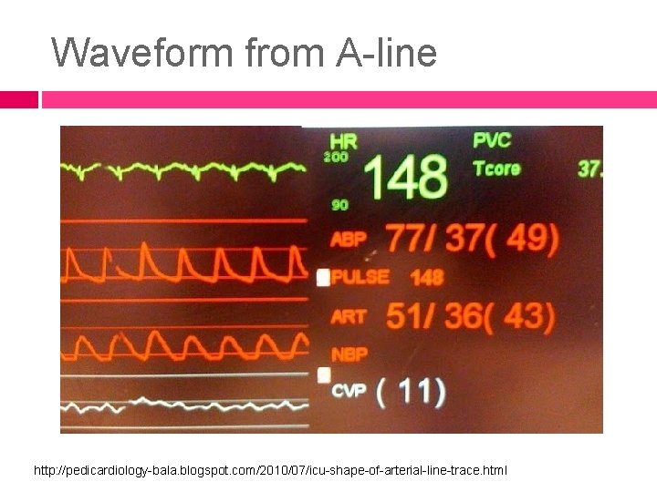Waveform from A-line http: //pedicardiology-bala. blogspot. com/2010/07/icu-shape-of-arterial-line-trace. html 