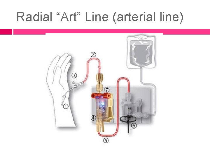 Radial “Art” Line (arterial line) 