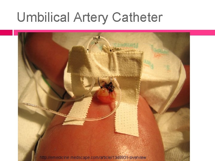 Umbilical Artery Catheter http: //emedicine. medscape. com/article/1348931 -overview 