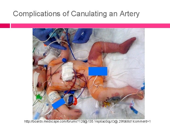 Complications of Canulating an Artery http: //boards. medscape. com/forums? 128@135. Yep 6 ao. Sqj.