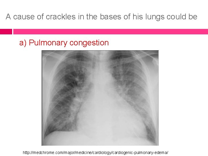 A cause of crackles in the bases of his lungs could be a) Pulmonary