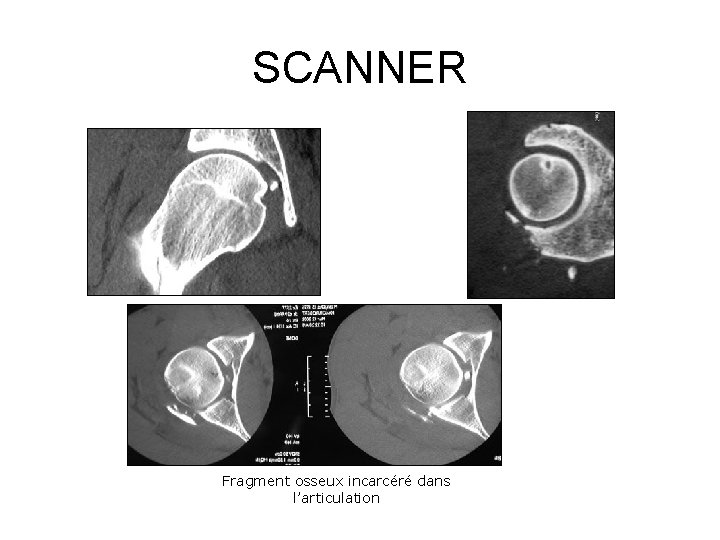 SCANNER Fragment osseux incarcéré dans l’articulation 