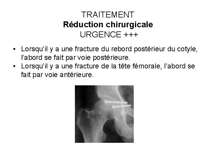 TRAITEMENT Réduction chirurgicale URGENCE +++ • Lorsqu’il y a une fracture du rebord postérieur