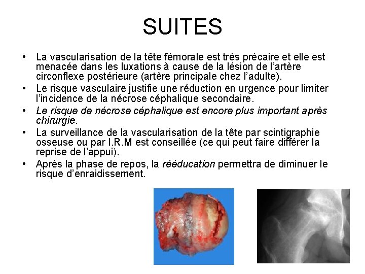 SUITES • La vascularisation de la tête fémorale est très précaire et elle est