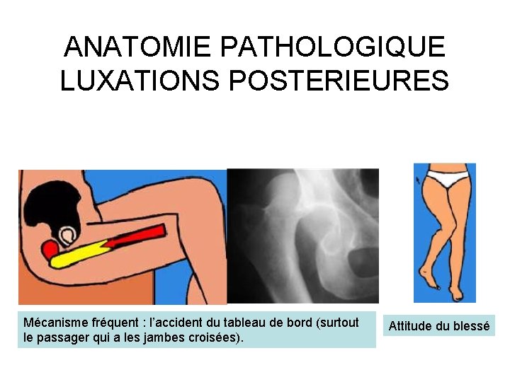 ANATOMIE PATHOLOGIQUE LUXATIONS POSTERIEURES Mécanisme fréquent : l’accident du tableau de bord (surtout le