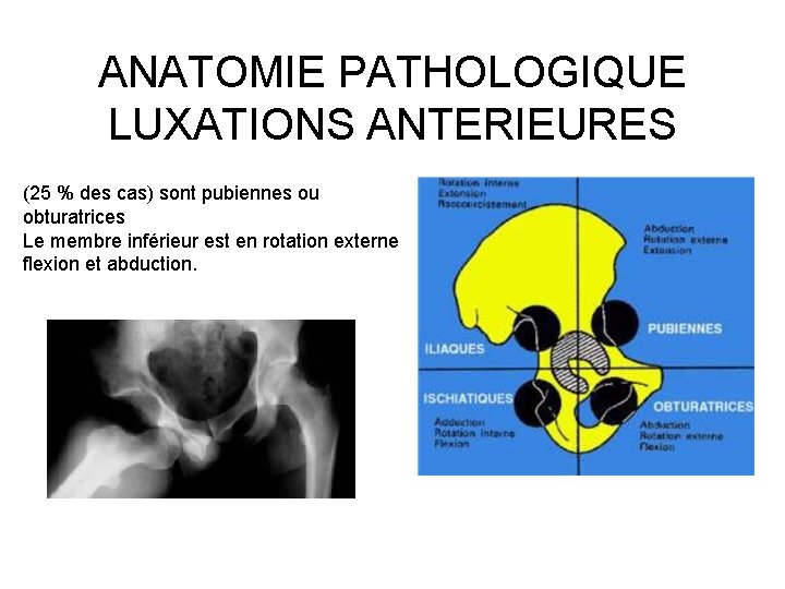 ANATOMIE PATHOLOGIQUE LUXATIONS ANTERIEURES (25 % des cas) sont pubiennes ou obturatrices Le membre