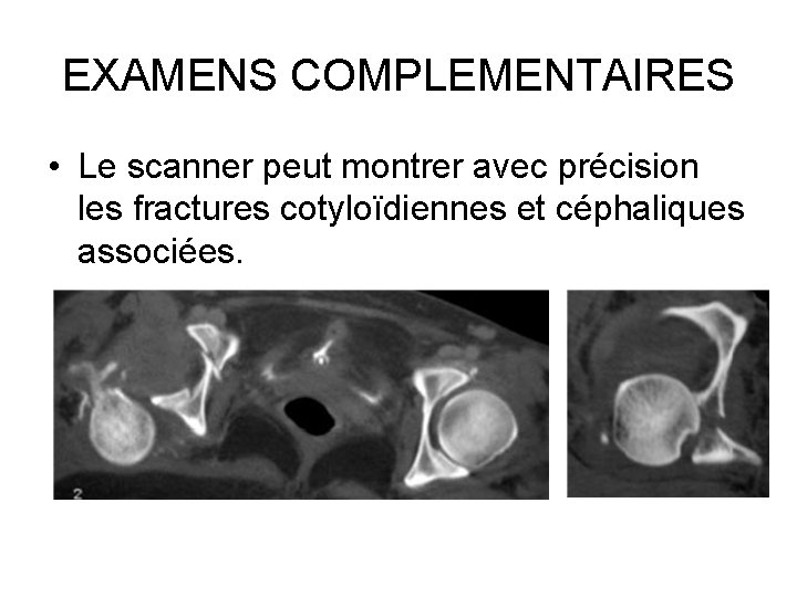 EXAMENS COMPLEMENTAIRES • Le scanner peut montrer avec précision les fractures cotyloïdiennes et céphaliques