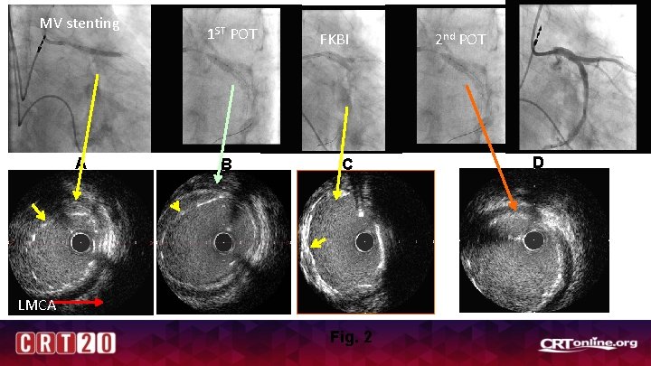 MV stenting A 1 ST POT B FKBI C LMCA Fig. 2 2 nd