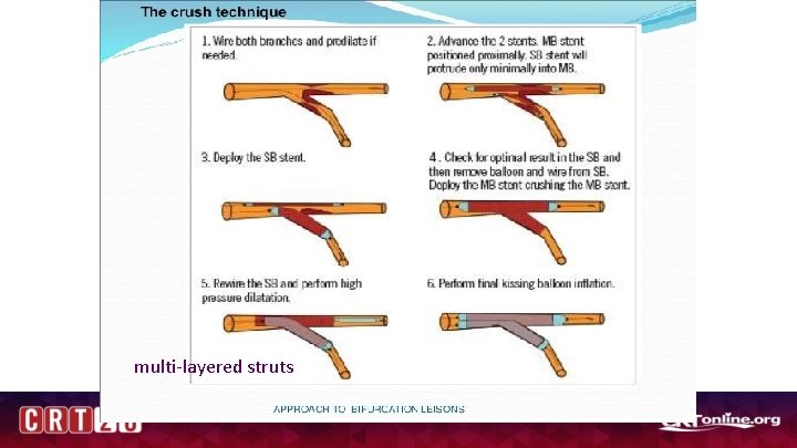 multi-layered struts 