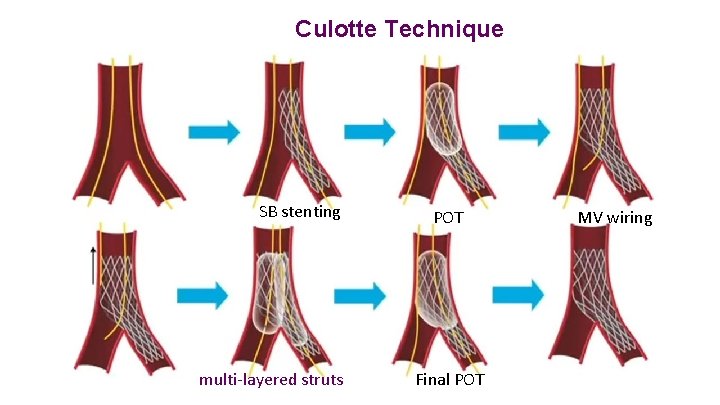 Culotte Technique SB stenting multi-layered struts POT Final POT MV wiring 