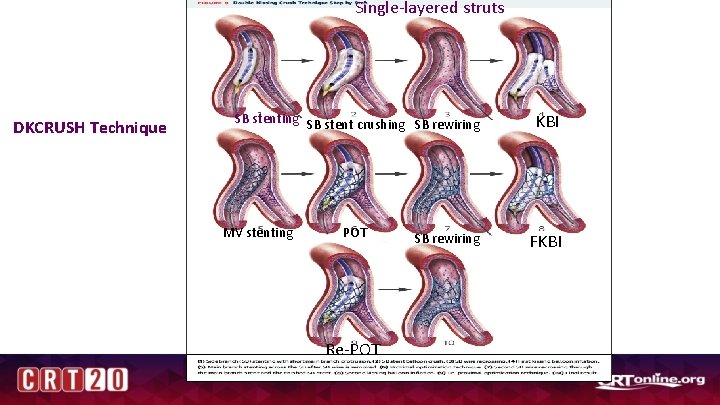 Single-layered struts DKCRUSH Technique SB stenting SB stent crushing SB rewiring MV stenting POT