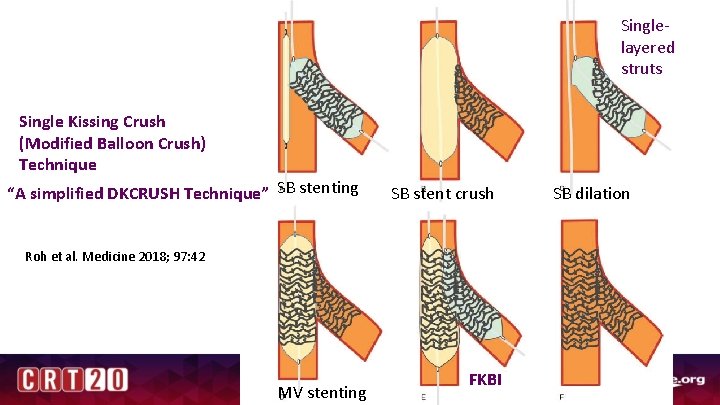 Singlelayered struts Single Kissing Crush (Modified Balloon Crush) Technique “A simplified DKCRUSH Technique” SB