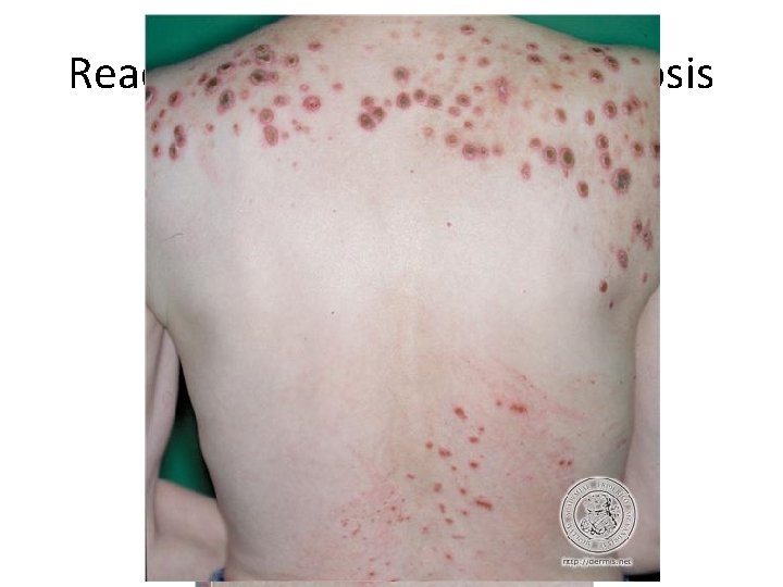 Reactive Perforating Collagenosis 