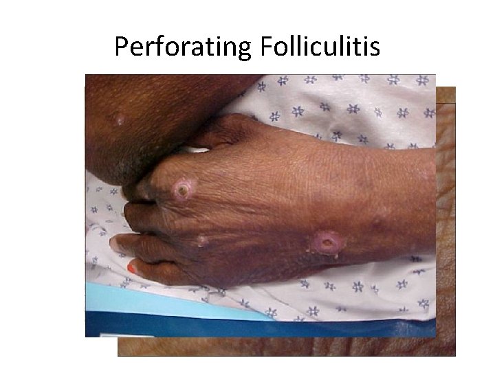 Perforating Folliculitis 