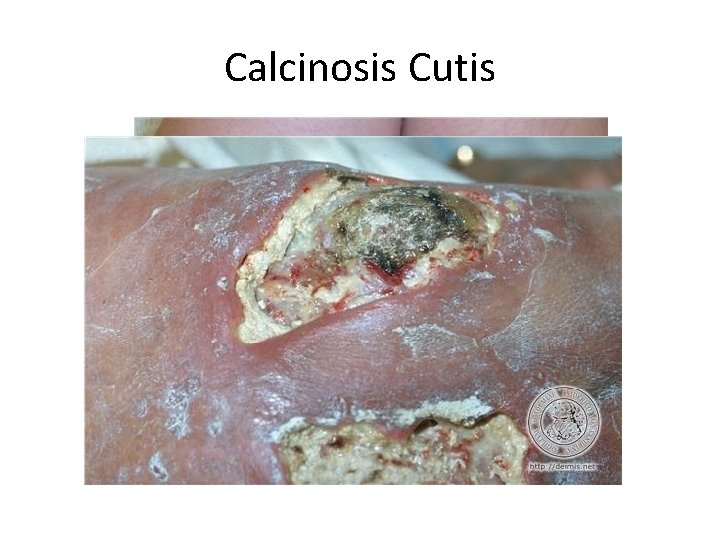 Calcinosis Cutis 