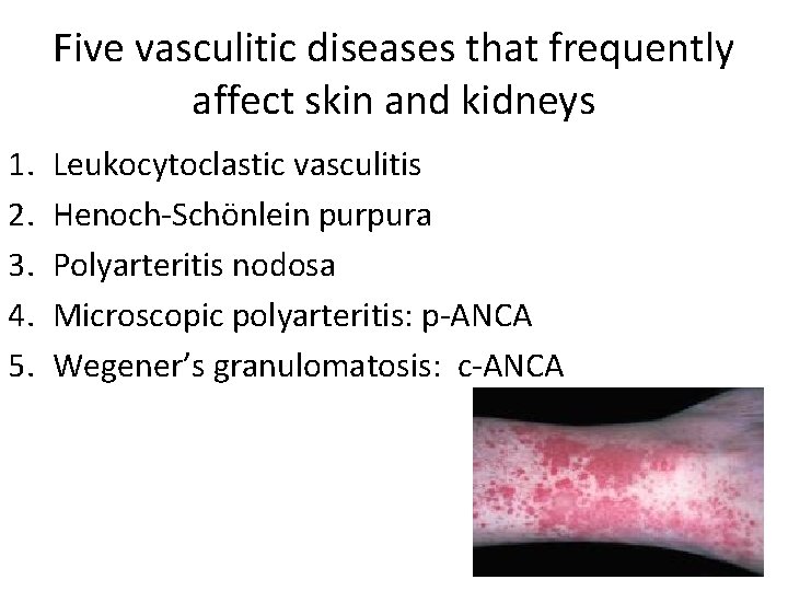 Five vasculitic diseases that frequently affect skin and kidneys 1. 2. 3. 4. 5.