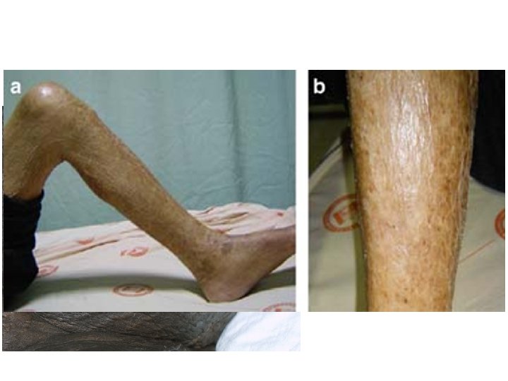  • Nephrogenic fibrosing dermopathy on the abdomen, demonstrating a peau d'orange appearance 