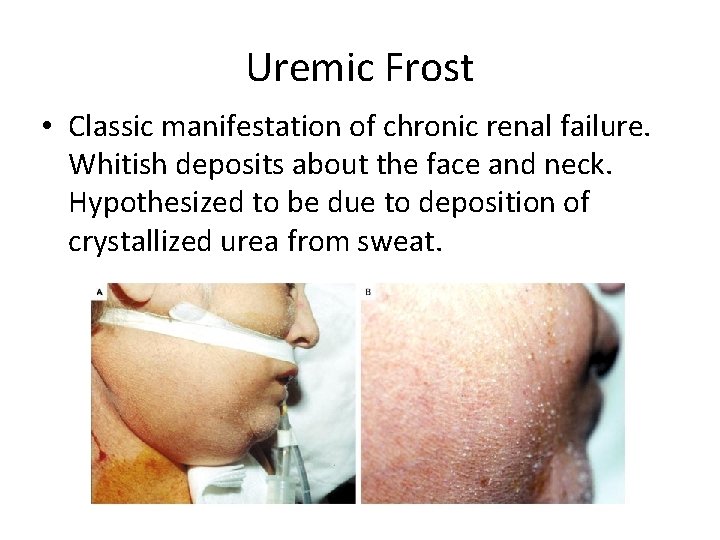 Uremic Frost • Classic manifestation of chronic renal failure. Whitish deposits about the face