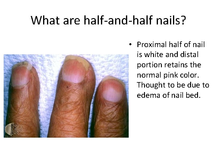 What are half-and-half nails? • Proximal half of nail is white and distal portion