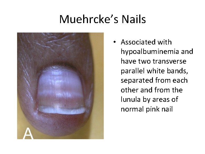 Muehrcke’s Nails • Associated with hypoalbuminemia and have two transverse parallel white bands, separated