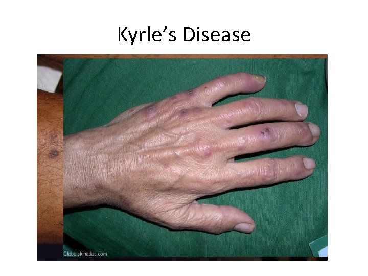 Kyrle’s Disease 