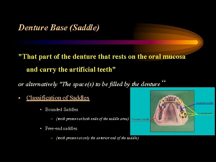 Denture Base (Saddle) "That part of the denture that rests on the oral mucosa