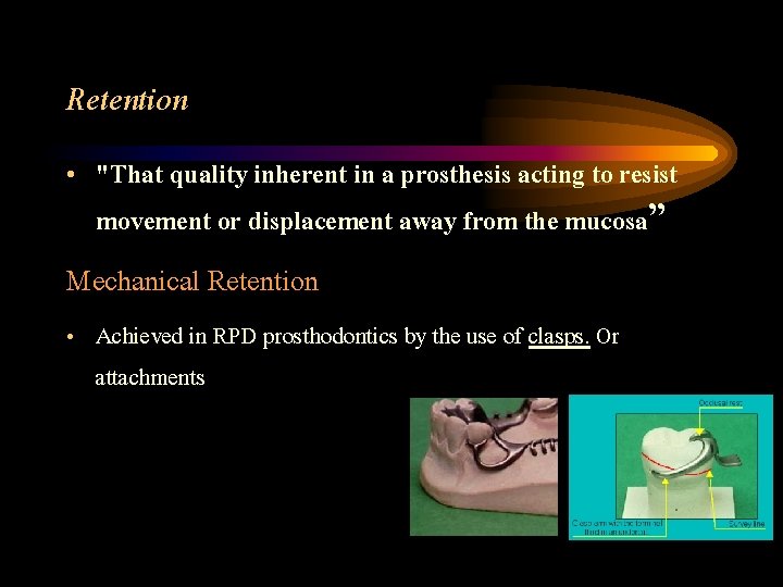 Retention • "That quality inherent in a prosthesis acting to resist movement or displacement