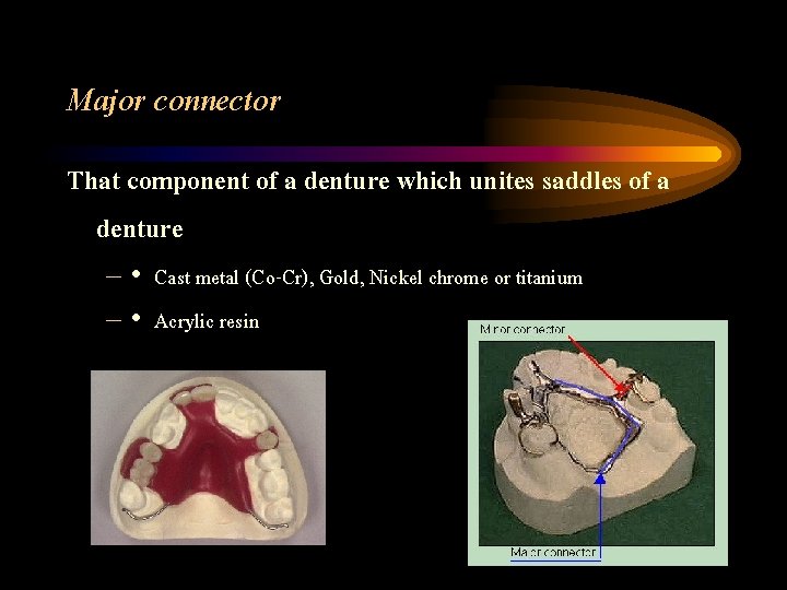 Major connector That component of a denture which unites saddles of a denture –
