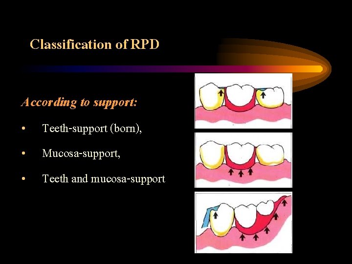 Classification of RPD According to support: • Teeth-support (born), • Mucosa-support, • Teeth and
