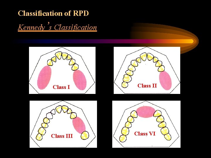 Classification of RPD Kennedy’s Classification Class III Class VI 