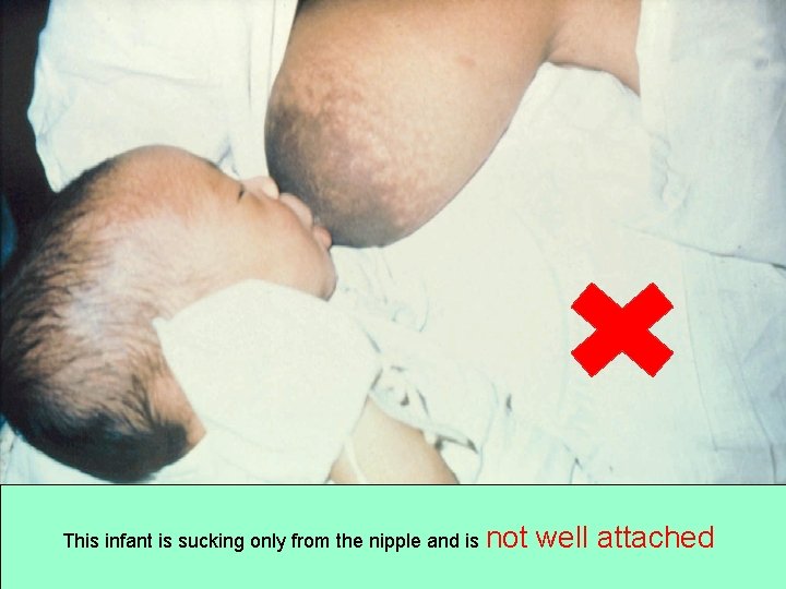 This infant is sucking only from the nipple and is not well attached 5/5